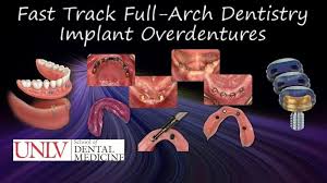 Michael Scherer - Fast Track Full-Arch Dentistry Implant Overdentures